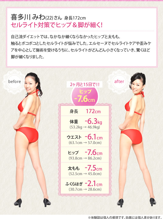 触るとボコボコとしたセルライトが悩みでした。エルセーヌでセルライトケアや歪みケアを中心として施術を受けるうちに、セルライトがどんどん小さくなっていき、驚くほど脚が細くなりました。