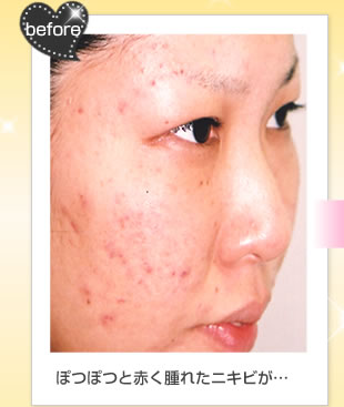 before ぽつぽつと赤く腫れたニキビが…