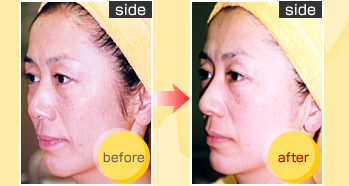 side before��after