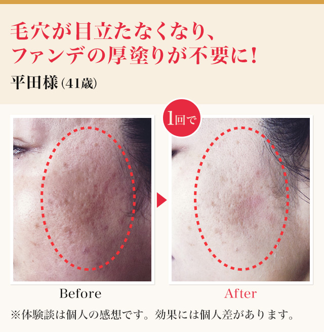 若見えハリ美肌コース｜エステのエルセーヌ