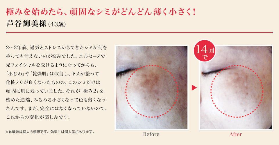「極みを始めたら、頑固なシミがどんどん薄く小さく!」芦谷輝美様(43歳)