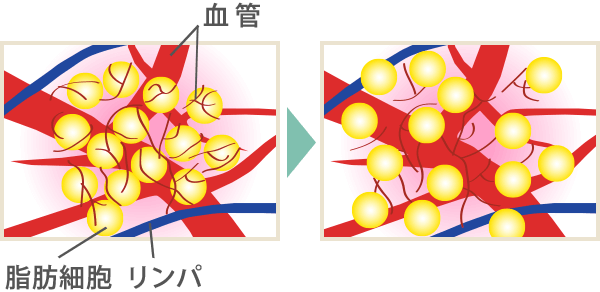セルライト｜エステのエルセーヌ