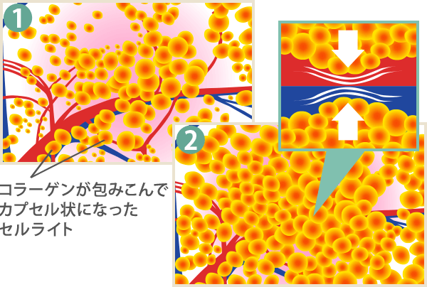 セルライト エステのエルセーヌ