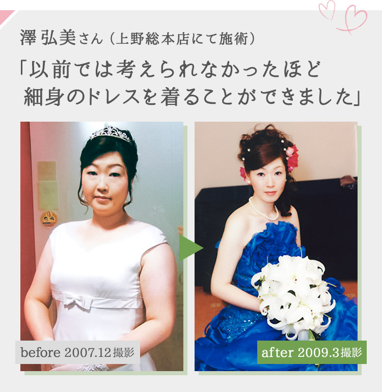 澤弘美さん（上野総本店にて施術）「以前では考えられなかったほど細身のドレスを着ることができました」