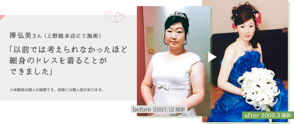 澤弘美さん（上野総本店にて施術）「以前では考えられなかったほど細身のドレスを着ることができました」