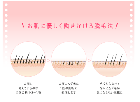お肌に優しく働きかける脱毛法