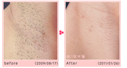 before/after 約1年半後
