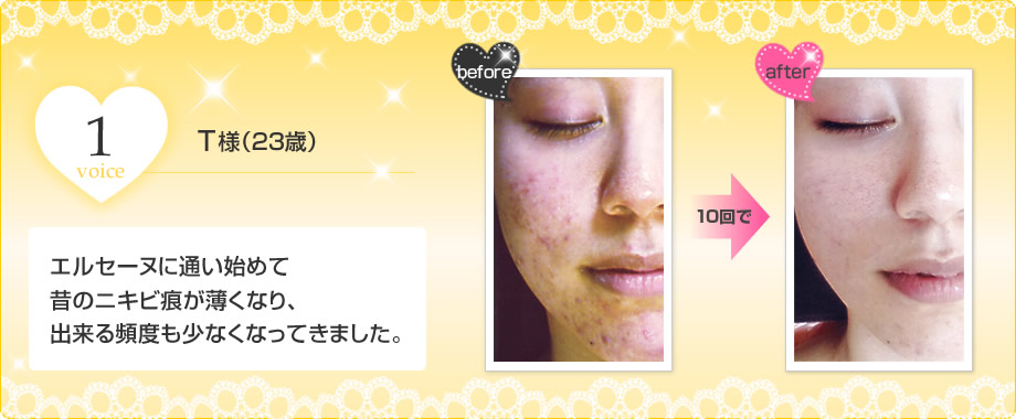 T様「エルセーヌに通い始めて昔のニキビ痕が薄くなり、出来る頻度も少なくなってきました。」