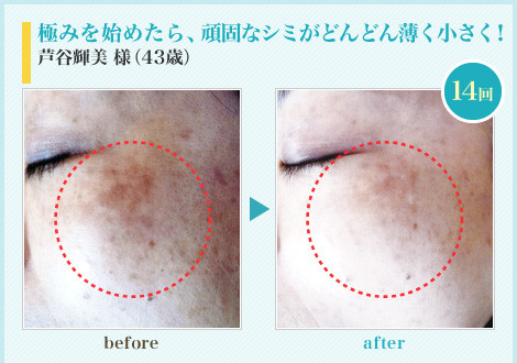 極みを始めたら、頑固なシミがどんどん薄く小さく!芦屋様(43歳)
