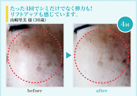 たった4回でシミだけでなく弾力も!リフトアップも感じています。山崎様(36歳)