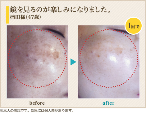 鏡を見るのが楽しみになりました。楠田様(47歳)