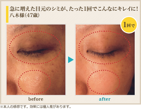 急に増えた目元のシミが、たった1回でこんなにキレイに!八木様(47歳)