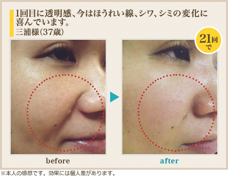 1回目に透明感、今はほうれい線、シワ、シミの変化に喜んでいます。三浦様(37歳)