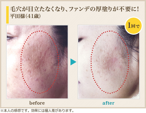 毛穴が目立たなくなり、ファンデの厚塗りが不要に!平田様(41歳)