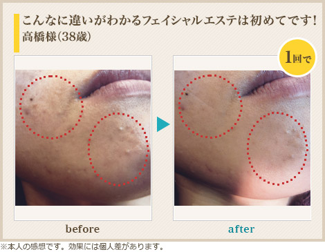 こんなに違いがわかるフェイシャルエステは初めてです!高橋様(38歳)