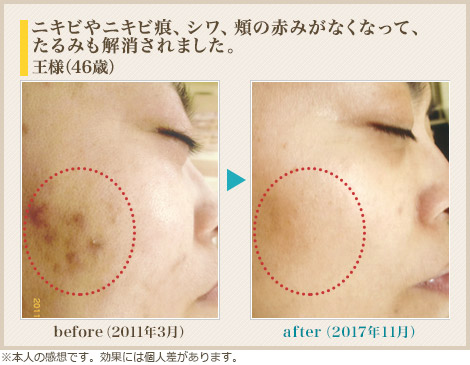 ニキビやニキビ痕、シワ、頬の赤みがなくなって、たるみも解消されました。王様(46歳)